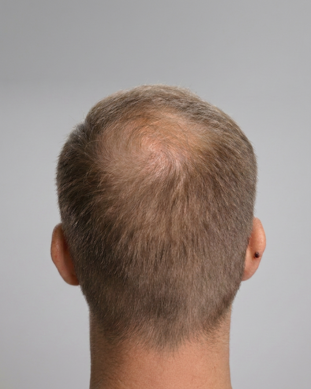 Crown thinning